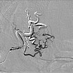 Digitale Subtraktionsangiographie – Stirn