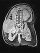 MRT – Kaposiformes Hämangioendotheliom