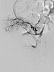 Embolisation – Kaposiformes Hämangioendotheliom