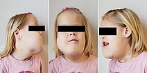 Lymphatische Malformation – Gesicht