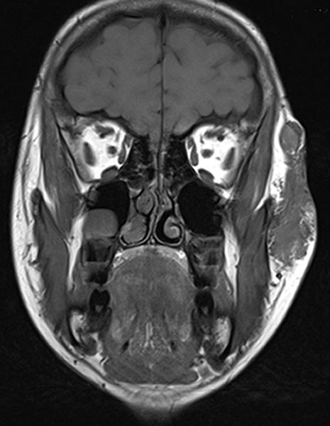 MRT – venöse Malformation an Wange