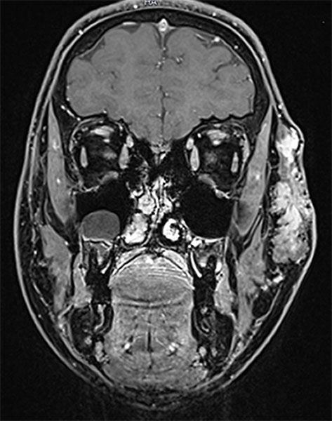 MRT – venöse Malformation an Wange