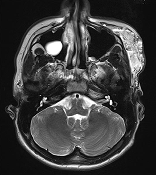 MRT des Gesichts – Venöse Malformation