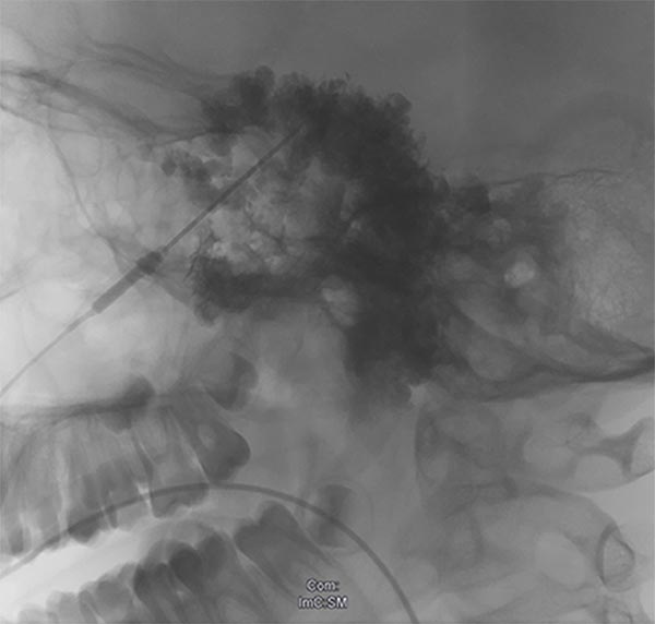 Sklerosierungstherapie – Venöse Malformation an Wange
