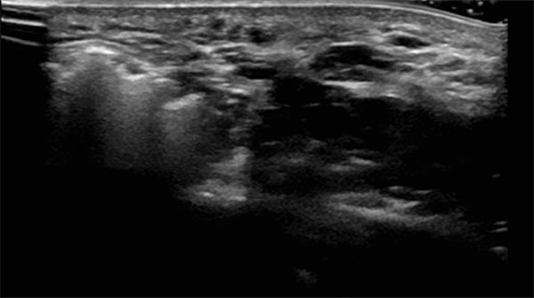 Sonographie während Sklerosierungsbehandlung