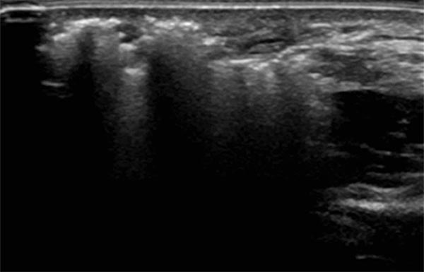 Sonographie während Sklerosierungsbehandlung