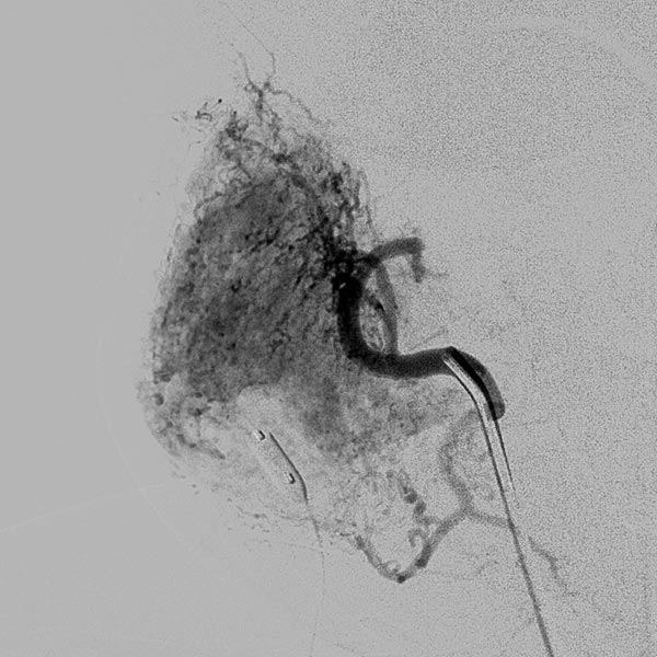 Digitale Subtraktionsangiographie – Infantiles Hämangiom