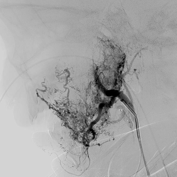 Digitale Subtraktionsangiographie – Infantiles Hämangiom