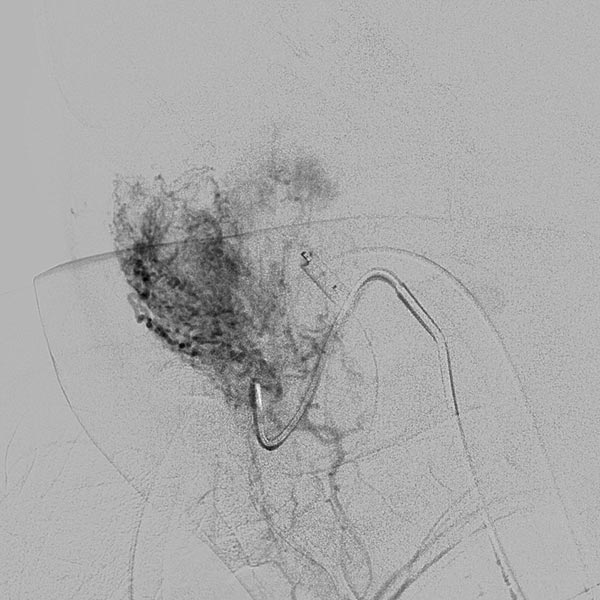 Digitale Subtraktionsangiographie – Infantiles Hämangiom