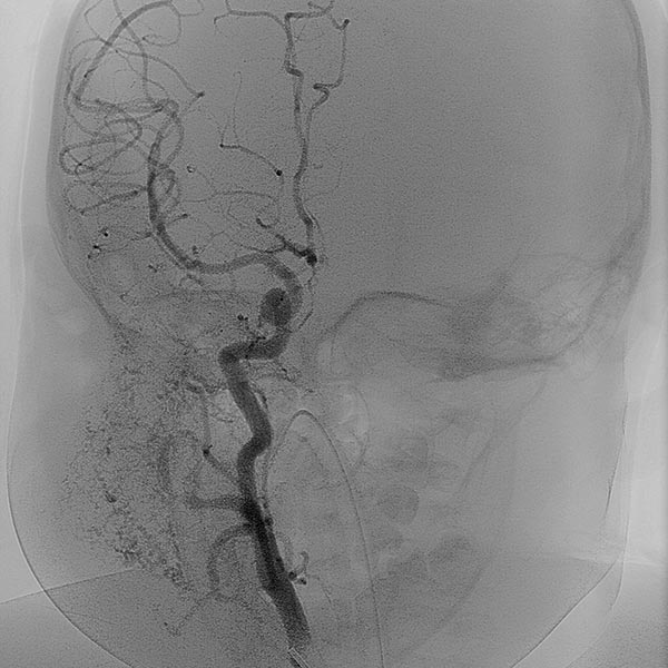 Digitale Subtraktionsangiographie – Infantiles Hämangiom