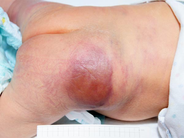 Kaposiformes Hämangioendotheliom bei Säugling