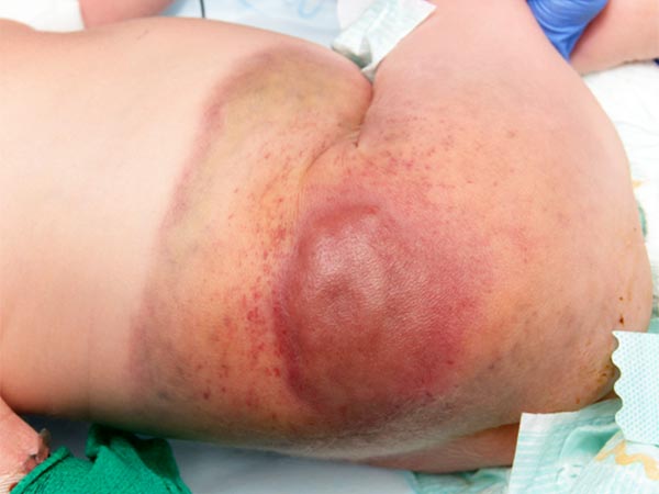 Kaposiformes Hämangioendotheliom bei Säugling