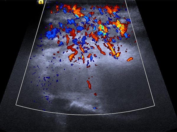 Sonographie – Kaposiformes Hämangioendotheliom