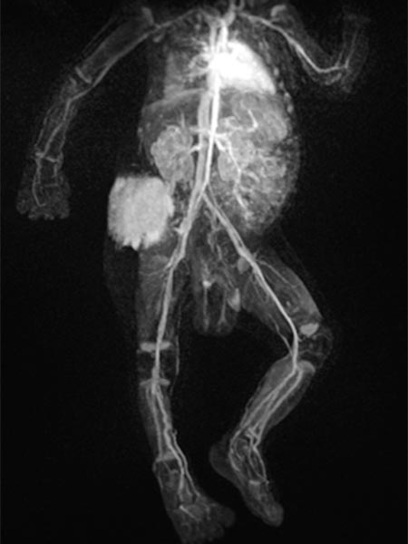 MR-Angiographie – Kaposiformes Hämangioendotheliom
