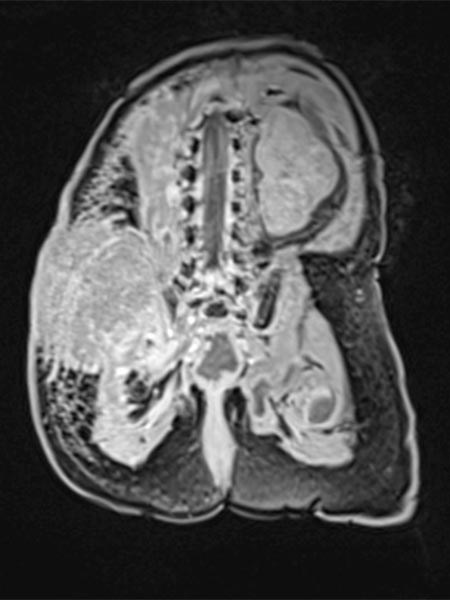 MRT – Kaposiformes Hämangioendotheliom