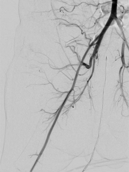 MR-Angiographie – Kaposiformes Hämangioendotheliom