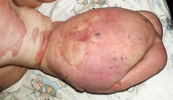 CLOVES-Syndrom an Vorfuß bei Weichteilhyperplasie