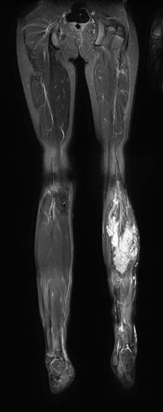 MRT – Fibro Adipose Vascular Anomaly an Wade
