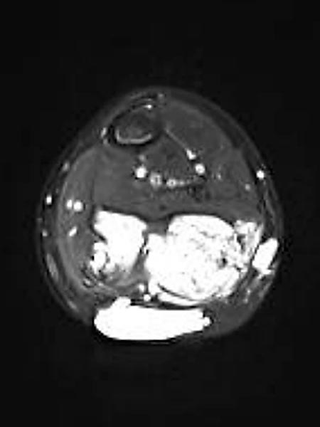 MRT – Fibro Adipose Vascular Anomaly an Wade
