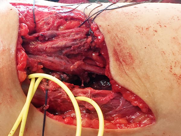 Operation – Fibro Adipose Vascular Anomaly an Wade
