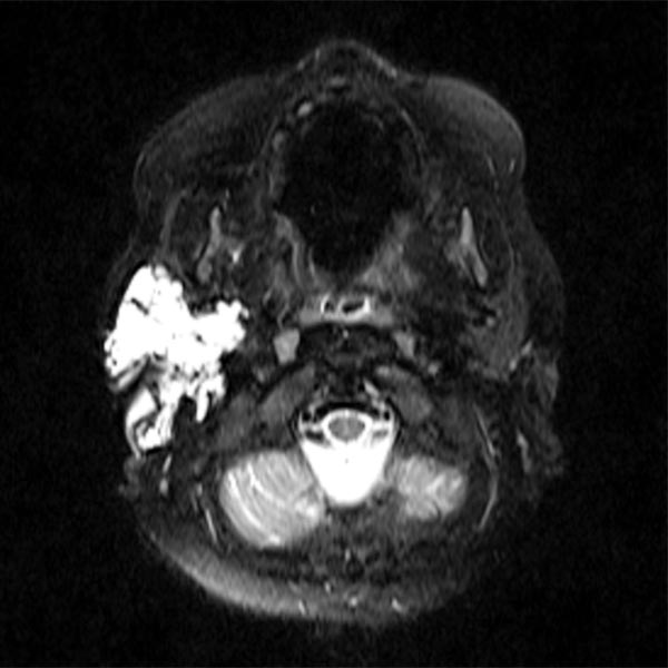MRT – Lymphatische Malformation der Parotis