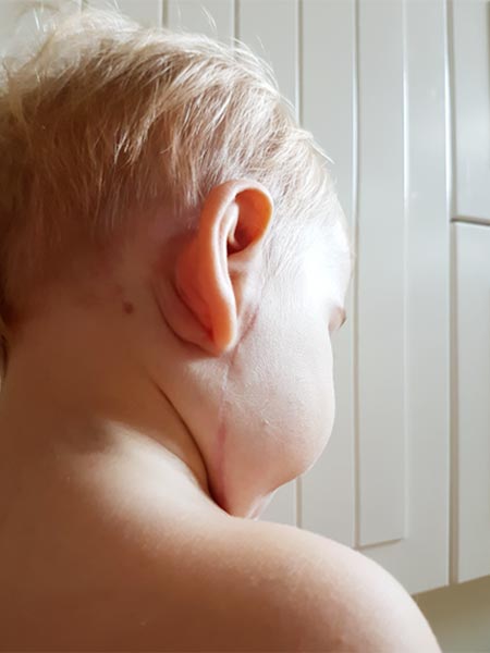 Nach Operation – Lymphatische Malformation der Parotis