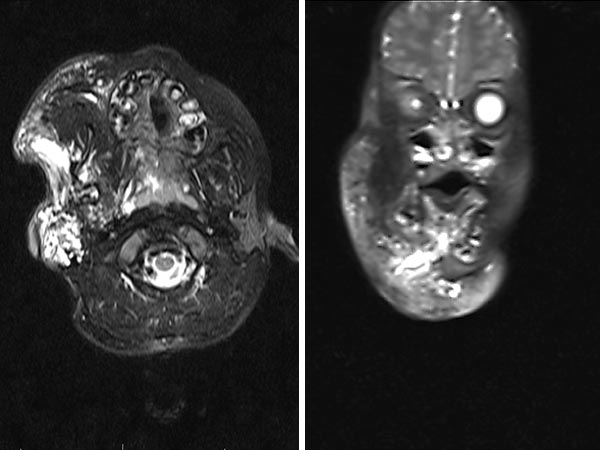 MRT – Lymphatische Malformation Gesicht