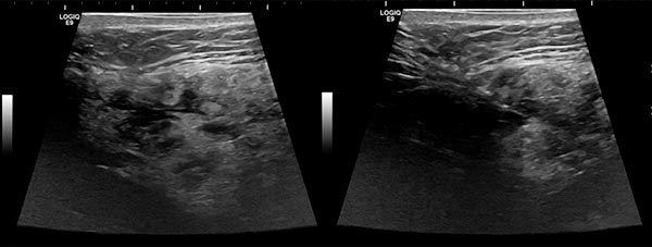 Sonographie – Venöse Malformation – Mund- Rachenraum