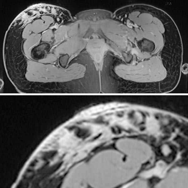 MRT T1 Wichtung – Lymphatische Malformation
