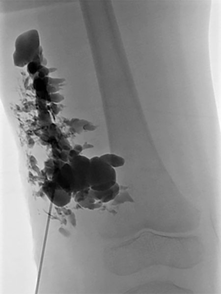 Sklerosierung – Klippel-Trénaunay-Syndrom, Lymphorrhoe am Bein