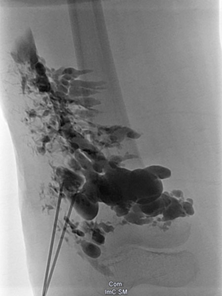 Sklerosierung – Klippel-Trénaunay-Syndrom, Lymphorrhoe am Bein