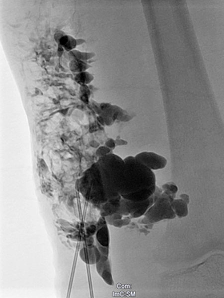 Sklerosierung – Klippel-Trénaunay-Syndrom, Lymphorrhoe am Bein