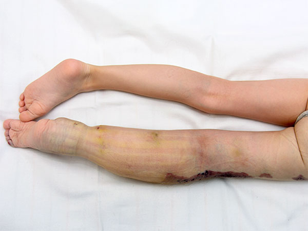 Nach Sklerosierung – Klippel-Trénaunay-Syndrom, Lymphorrhoe am Bein