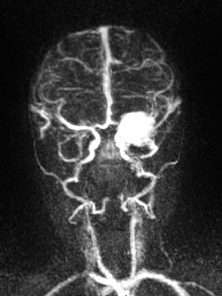 MR-Angiographie – Infantiles Hämangiom an Auge