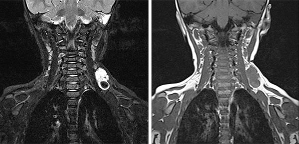 MRT – Venöse Malformation am Hals