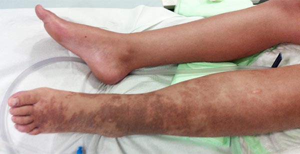 Parkes-Weber-Syndrom am Bein – nach Therapie