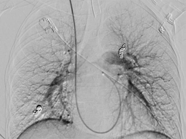 Digitale Subtraktionsangiographie – pulmonale AVM 