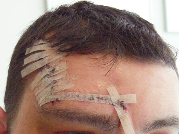 Bild nach Operation der arteriovenösen Malformation
