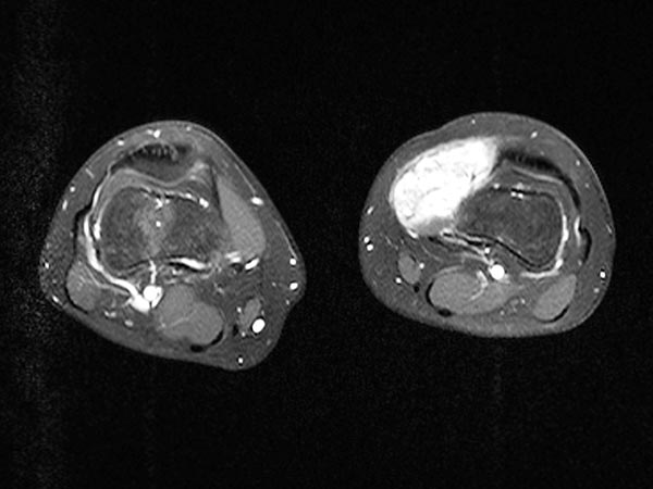 MRT – Venöse Malformation
