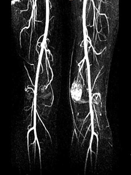MR-Angiographie – Venöse Malformation