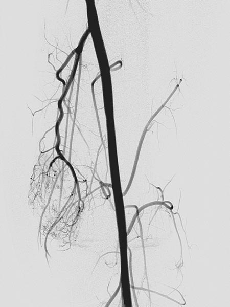 Digitale Subtraktionsangiographie – Venöse Malformation