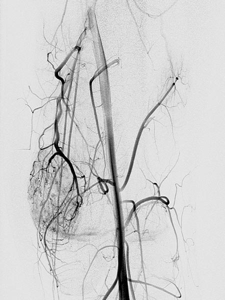 Digitale Subtraktionsangiographie – Venöse Malformation