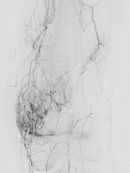 Digitale Subtraktionsangiographie – Venöse Malformation
