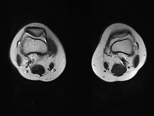 MRT – Venöse Malformation