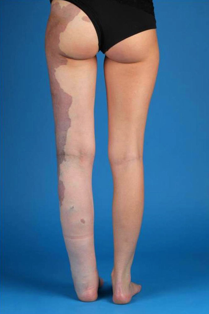Kapilläre Malformation (dunkelroter Hautfleck) mit Venöser Malformation (blaue Schwellungen)