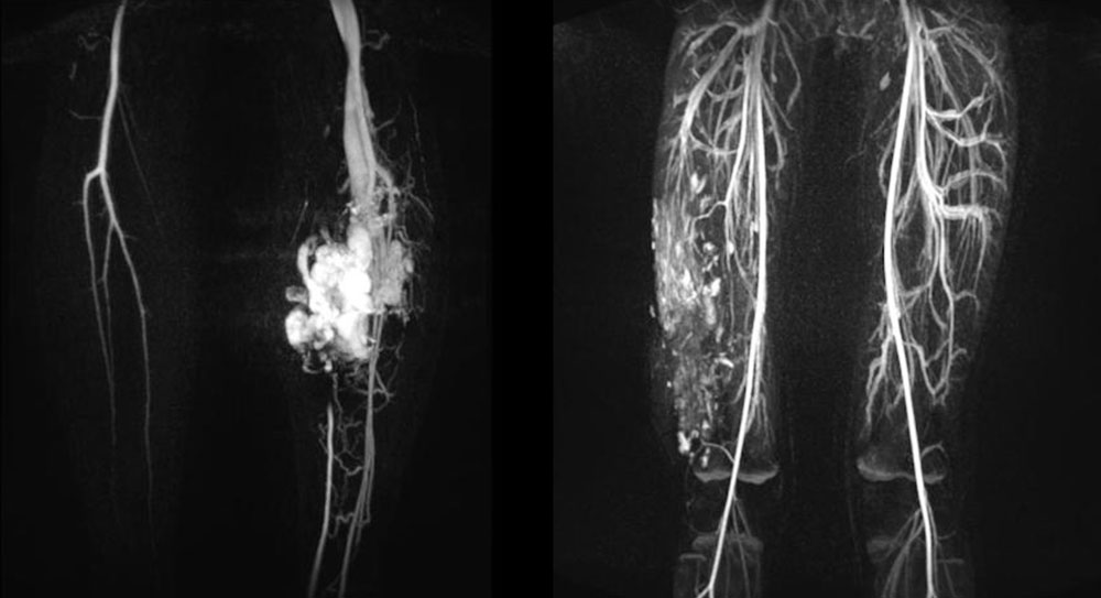 MR-Angiographien des Unterschenkels