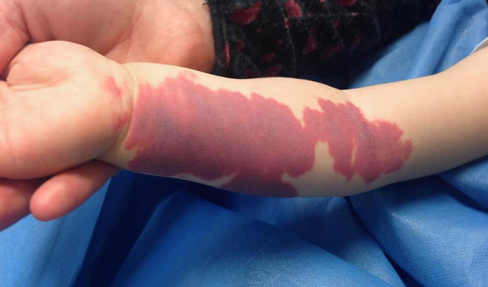 Kapilläre Malformation rechter Arm