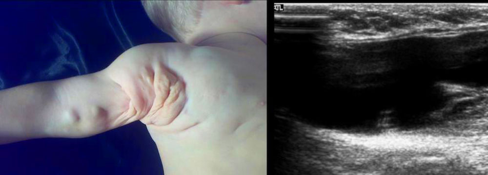 Lymphatische Malformation an der Axilla und am Arm