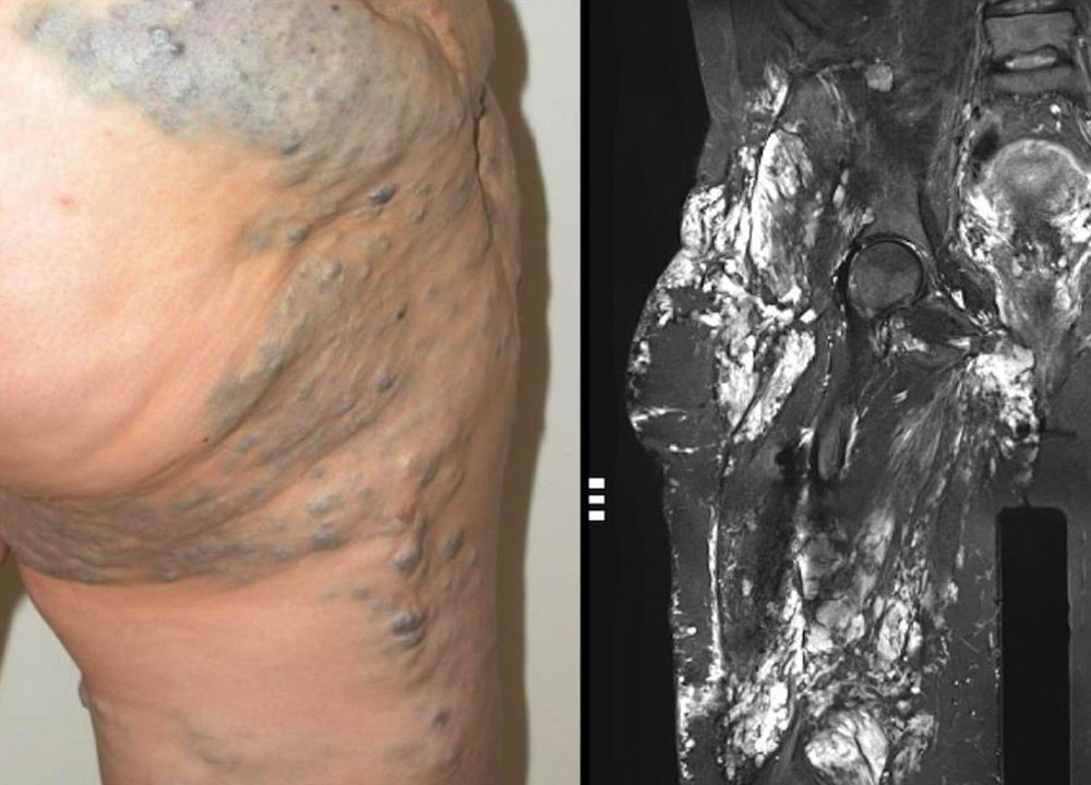 Ausgedehnte venöse Malformation