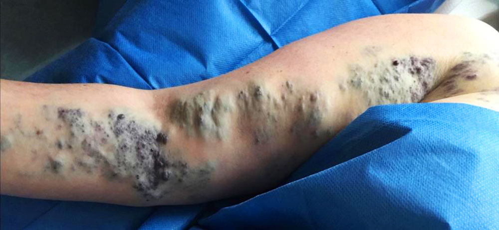 Venöse Malformation rechter Arm